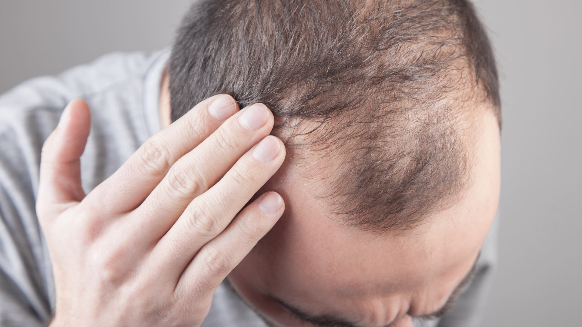 Hair Transplant: The 5 Most Common Fears