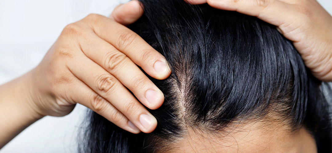 Hair loss: How to identify if it’s normal or alopecia?